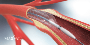 Medtronics Transcatheter Aortic Valve Replacement Speyside Medical