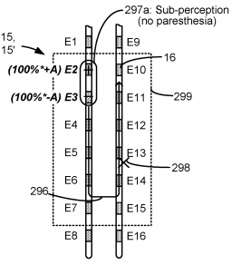 Patent Application for Paresthesia-Free Spinal Cord Stimulation