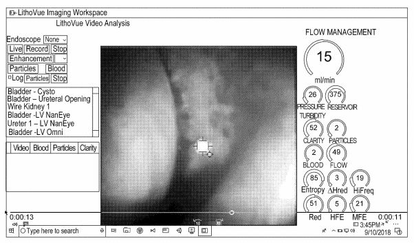 Endoscopic video display of a kidney stone