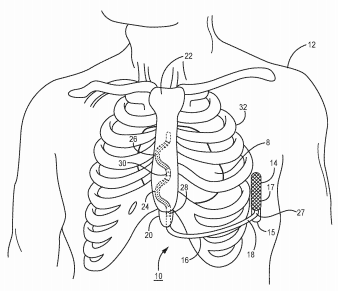 Medical Device for Tachyarrhythmia Detection