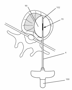 intervertebral disc