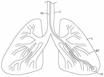 Boston Scientific Seeks to Patent a Biopsy Needle for Accessing Peripheral Lung Nodules