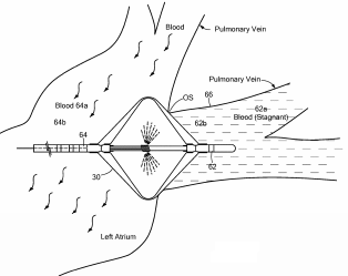 Vein Occlusion Assessment System