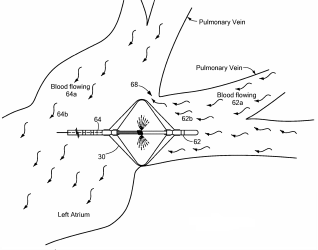 Medtronic Eyes a Patent for a Vein Occlusion Assessment System