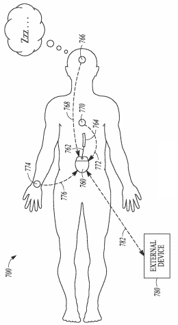 Boston Scientific Files a Patent for a Pain Management System with Sleep Detection