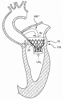 Medtronic Files a Patent for a Heart Valve Prosthesis with a Torque Anchoring Mechanism