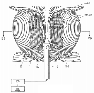 Prostate Treatment System Patent 