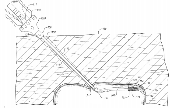 Abbott Seeks to Patent an Apparatus for Suturing Body Lumens