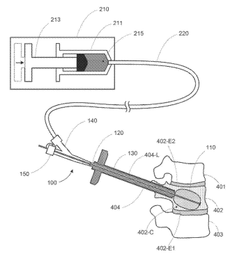 Medtronic Aims to Patent a Retractable Inflatable Bone Tamp