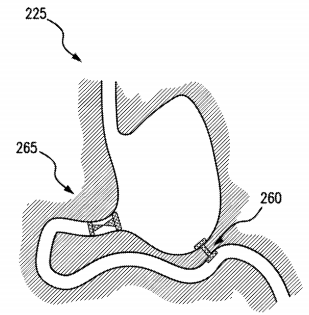 pyloric occlusion device