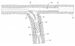 secondary vessel