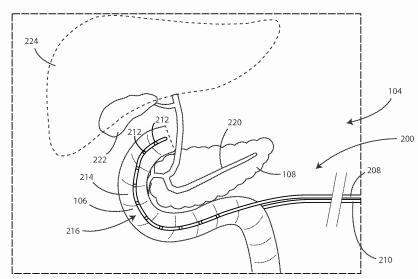 Boston Scientific Files a Patent for a Pancreatic Cancer Treatment Device