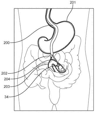 Patent for an Anastomotic Stent