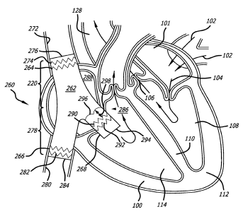 Bifurcated Tubular Graft