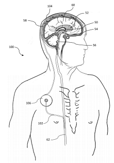 Medtronic Patent an Alzheimer's Disease Treatment Means