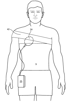 External Wireless Power Transfer Coil