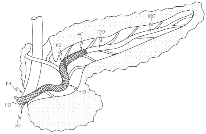 Boston Scientific Files a Patent for an Endoluminal Device