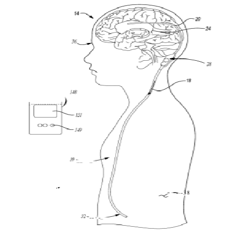 Medtronic Aims to Patent a System for Valve Control