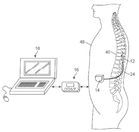 Boston Scientific Files a Patent for a Neurostimulation System