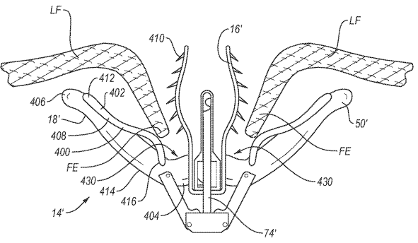 Patent a Fixation Implant for Tissue Repair