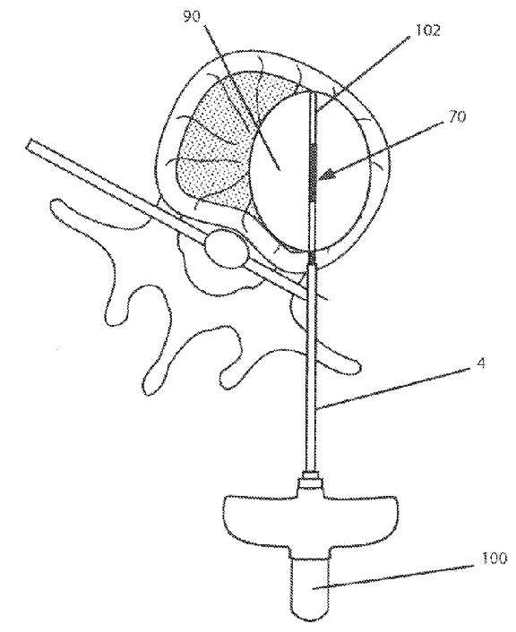 Medtronic Eyes a Patent for an Electrosurgical Device