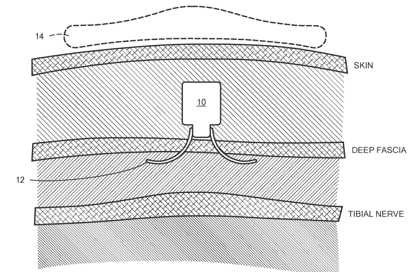 Medtronic Eyes a Patent for an Implantable Ultrasonic Device